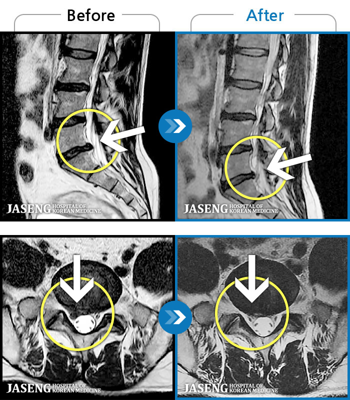자생한방병원 치료사례 MRI로 보는 치료결과-우측 골반부터 하지로 저림이 지속되며 자세 변경시에 통증이 더 심화되는 중등도 이상의 통증을 호소하는 상태였습니다.
