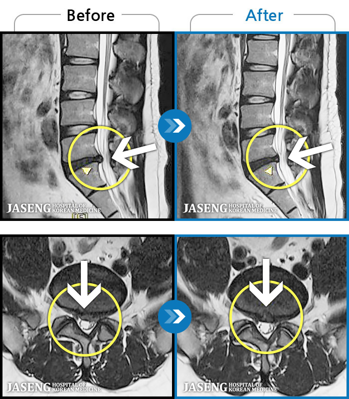 자생한방병원 치료사례 MRI로 보는 치료결과-양측 허리 통증과 좌측 허벅지까지 동반되는 저림증상 있고, 앉거나 걸을 때 통증 심화되어 내원하셨습니다.