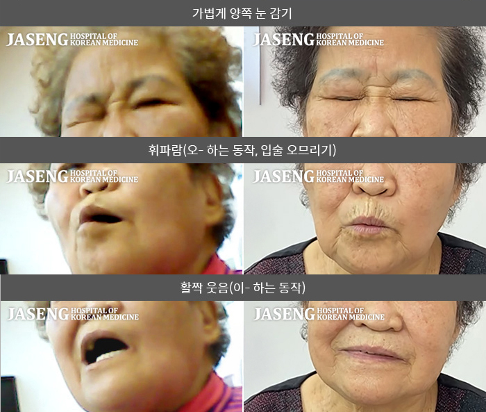 자생한방병원 치료사례 MRI로 보는 치료결과-왼쪽 귀 뒤가 아프더니 왼쪽 눈이 감기지 않아 눈물이 새고 입이 삐뚤어져 식사가 힘들다.