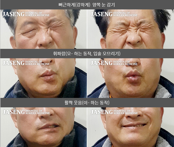 자생한방병원 치료사례 MRI로 보는 치료결과-눈물이 많이 나며, 이마 주름이 잡히지 않고 음수 시 물이 샜다.