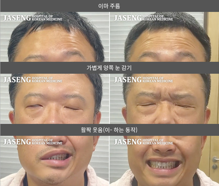 자생한방병원 치료사례 MRI로 보는 치료결과-오른쪽 눈이 잘 안 감기고 오른쪽 안면부 전체가 마비된 느낌이다.