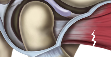 턱 근육, 인대의 손상