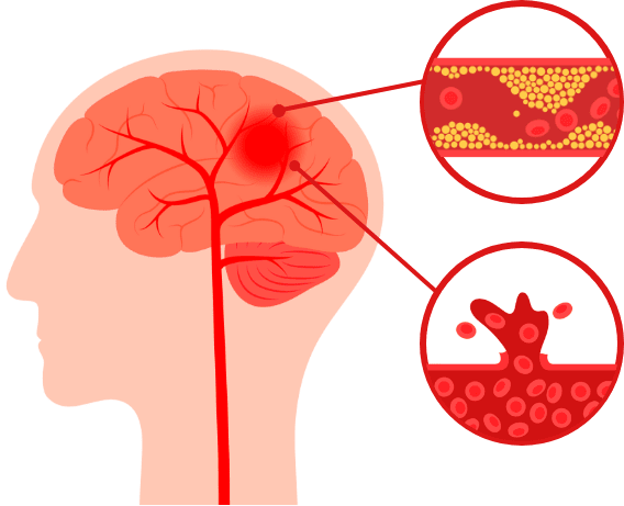 뇌혈관 손상과 혈류 장애를 표현한 일러스트