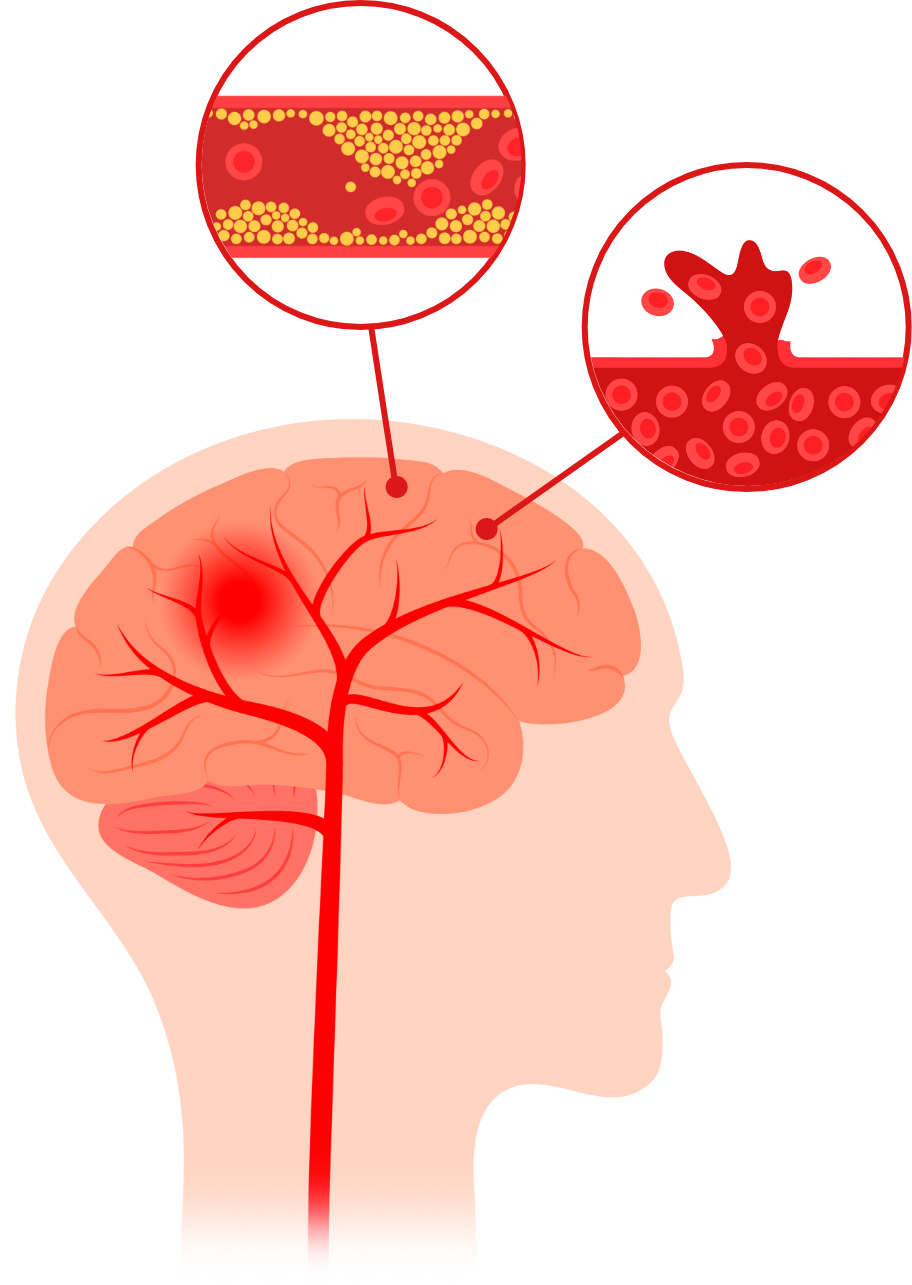 뇌혈관 손상과 혈류 장애를 표현한 일러스트