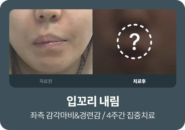 입꼬리 내림 / 좌측감각마비&경련감 / 4주간 집중치료