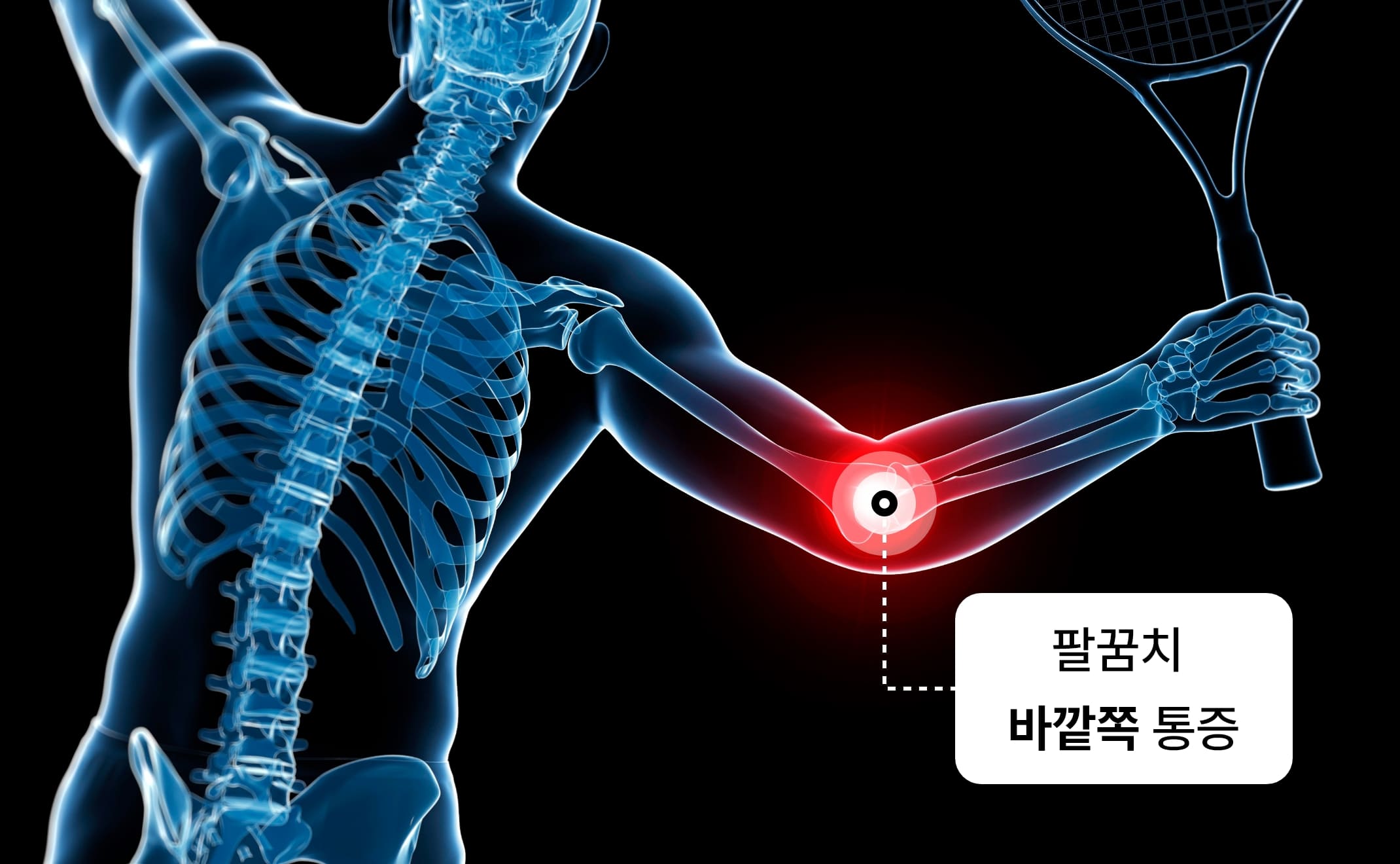 테니스 엘보-팔꿈치 바깥쪽 통증
